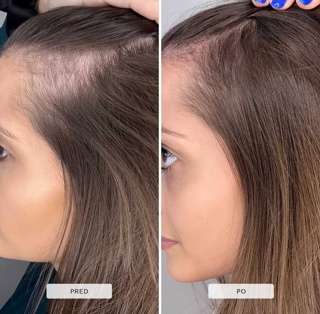 Multi-aktívne sérum scalp (na rast vlasov)